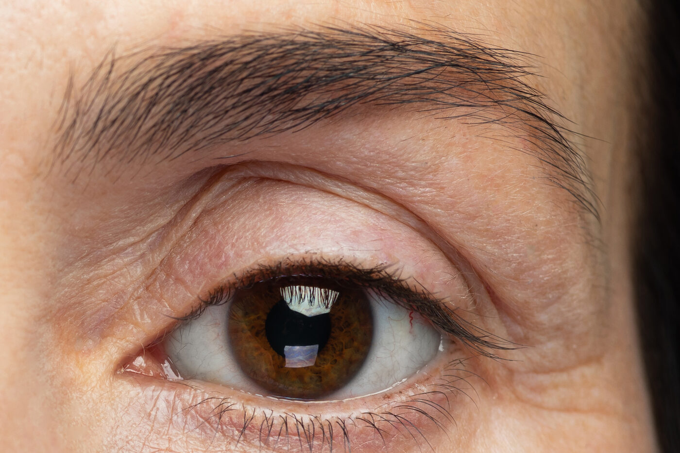 Close-up of an eye showing heavy upper-eyelid skin folding down towards the lashes